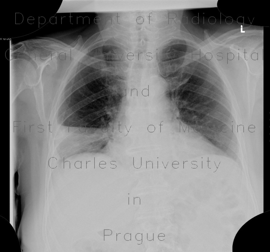 Lobar pneumonia
