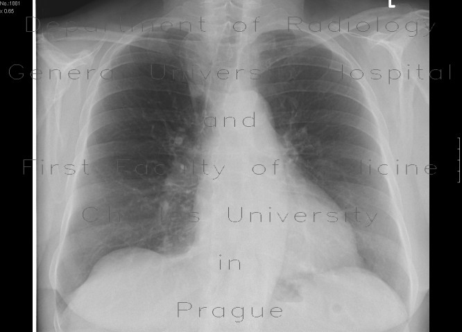 Lobus venae azygos, azygous lobe