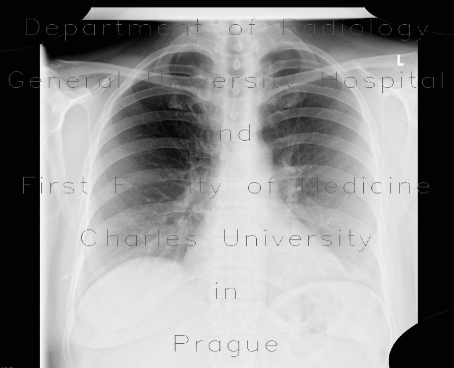 Lobus venae azygos, azygous vein lobe
