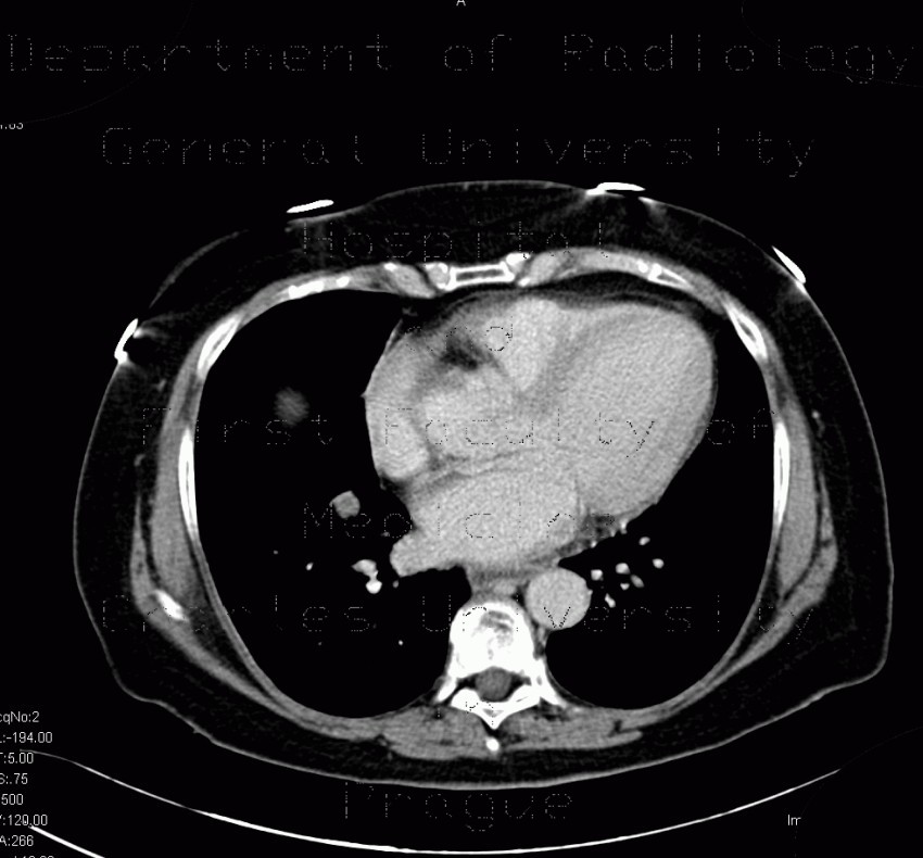Lung carcinoma, accidental finding on enterography