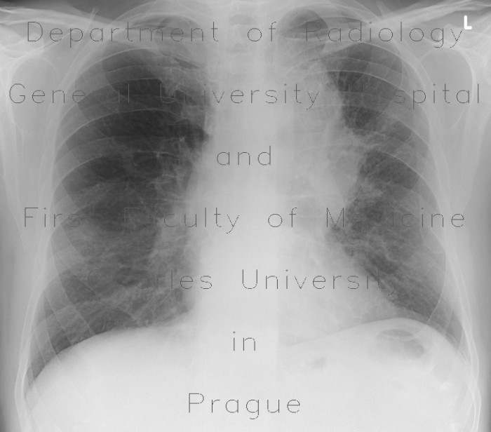 Lung carcinoma, metastasis