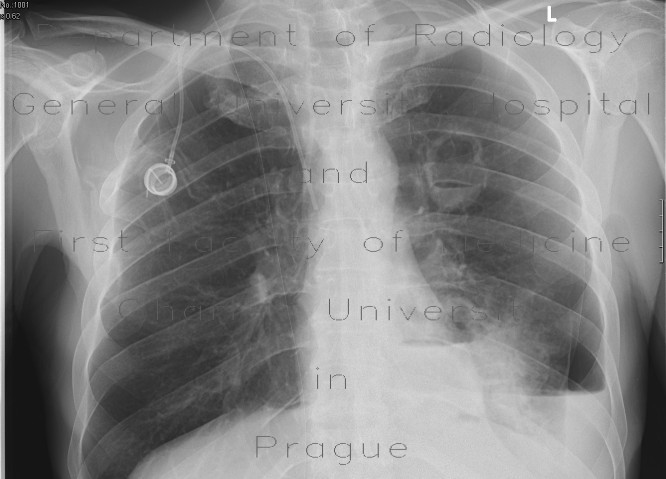 Lung cavity, pneumothorax, hydropneumothorax
