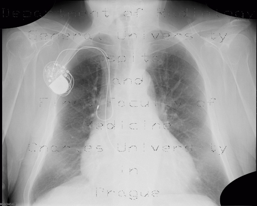 Lung congestion, first degree