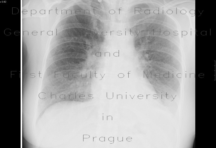 Lung congestion, uremic lung