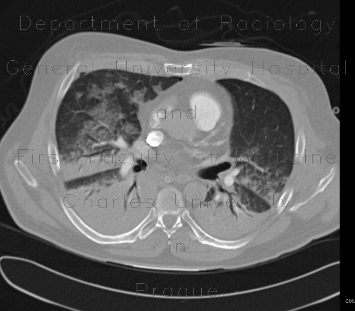 Lung contusion