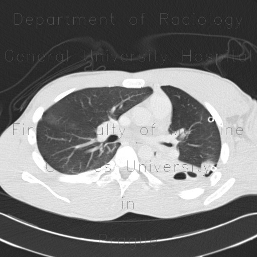Lung contusion, hemothorax, pneumothorax, chest tube