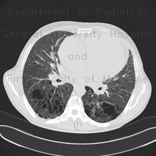 Lung fibrosis, severe