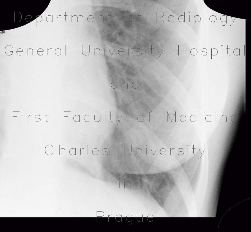 Lung infarction