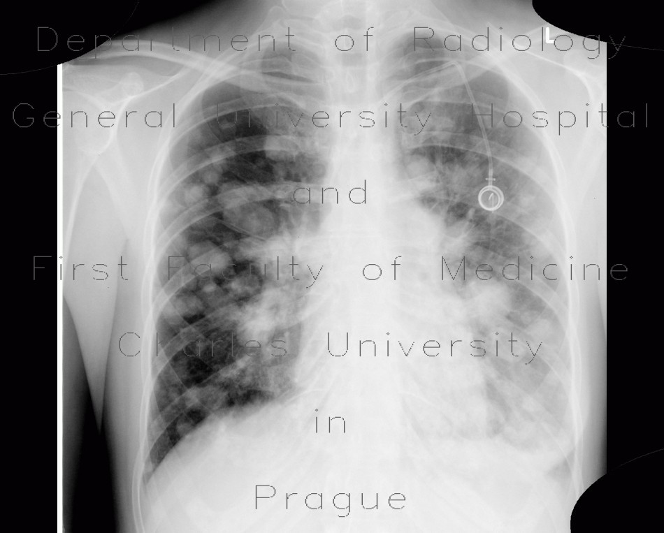 Lung metastases, cannon ball metastases