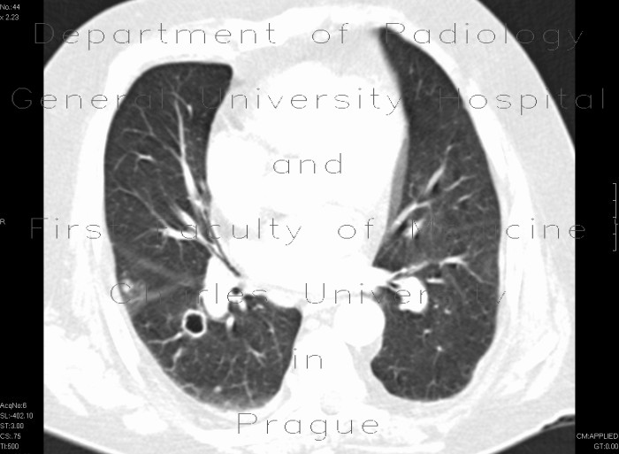 Lung metastases, cavitating