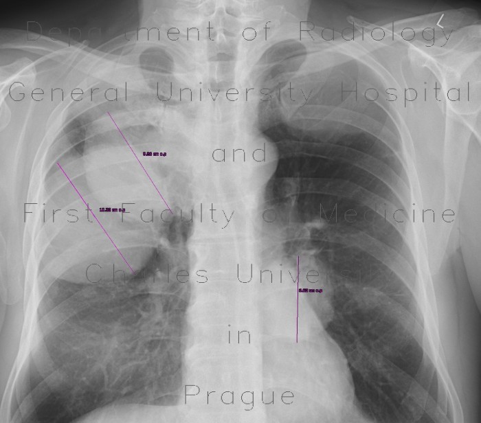 Lung metastases of renal cell carcinoma