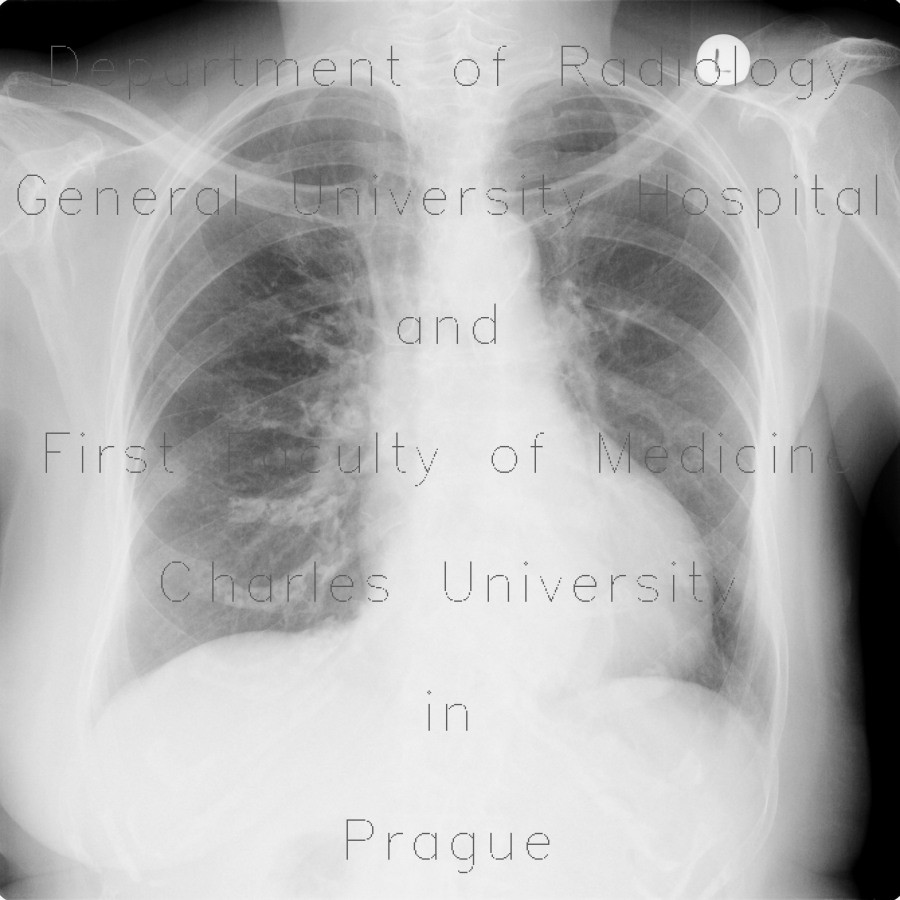 Lung opacity, chest radiograph, rib fracture, mimic of metastasis