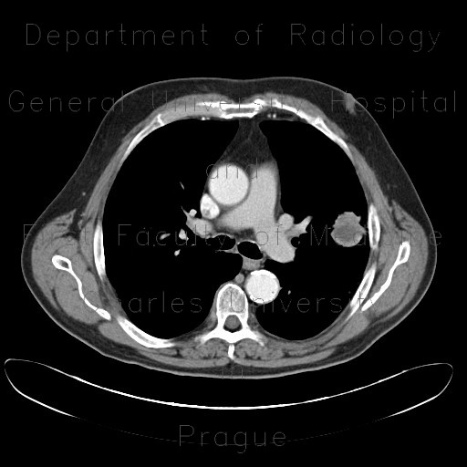 Lung tumour, bone metastasis in pubic bone, inguinal hernia
