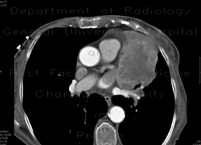 Lung tumour growing into the left atrium through a pulmonary vein