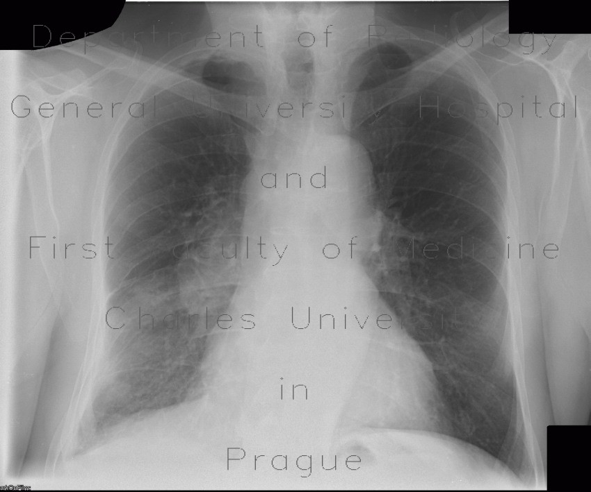Lung tumour, hilar lymphadenopathy, second radiograph