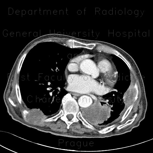 Lung tumour, osteolytic metastasis of ribs