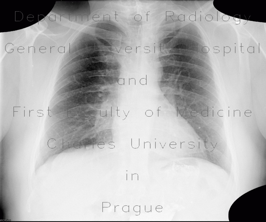 Lung tumour, postirradiation changes