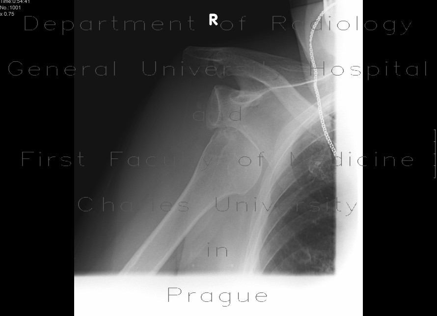 Luxation of the shoulder, caudal, axillary