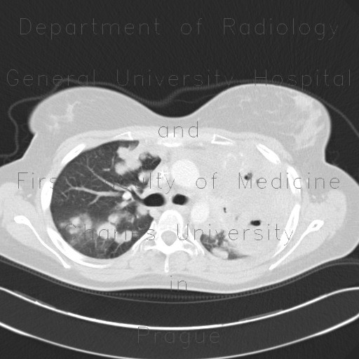 Lymphoma, extension of lymphoma in lung