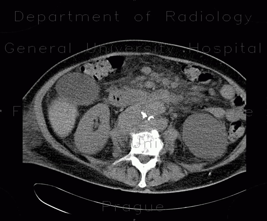 Lymphoma, mesenterial lymphadenopathy, edema of mesentery, correlation