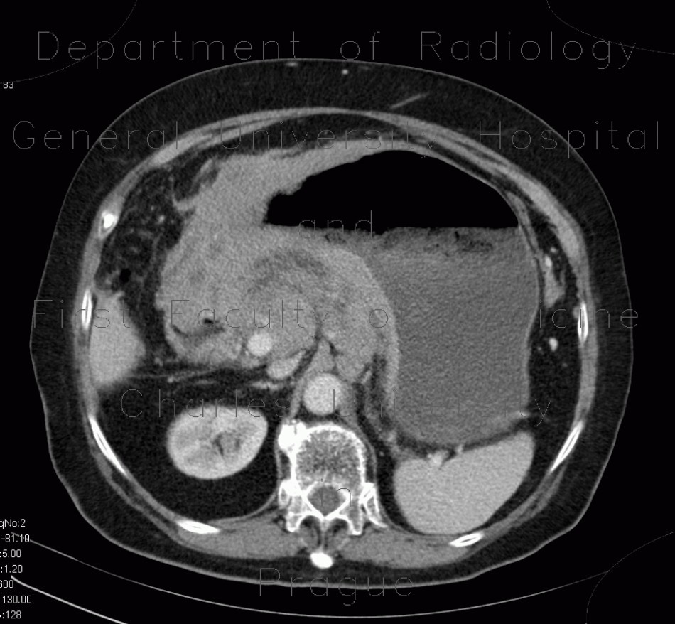 Lymphoma of stomach