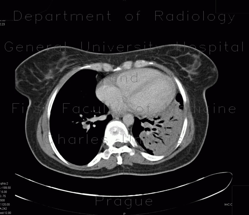 Lymphoma of the lung and spleen