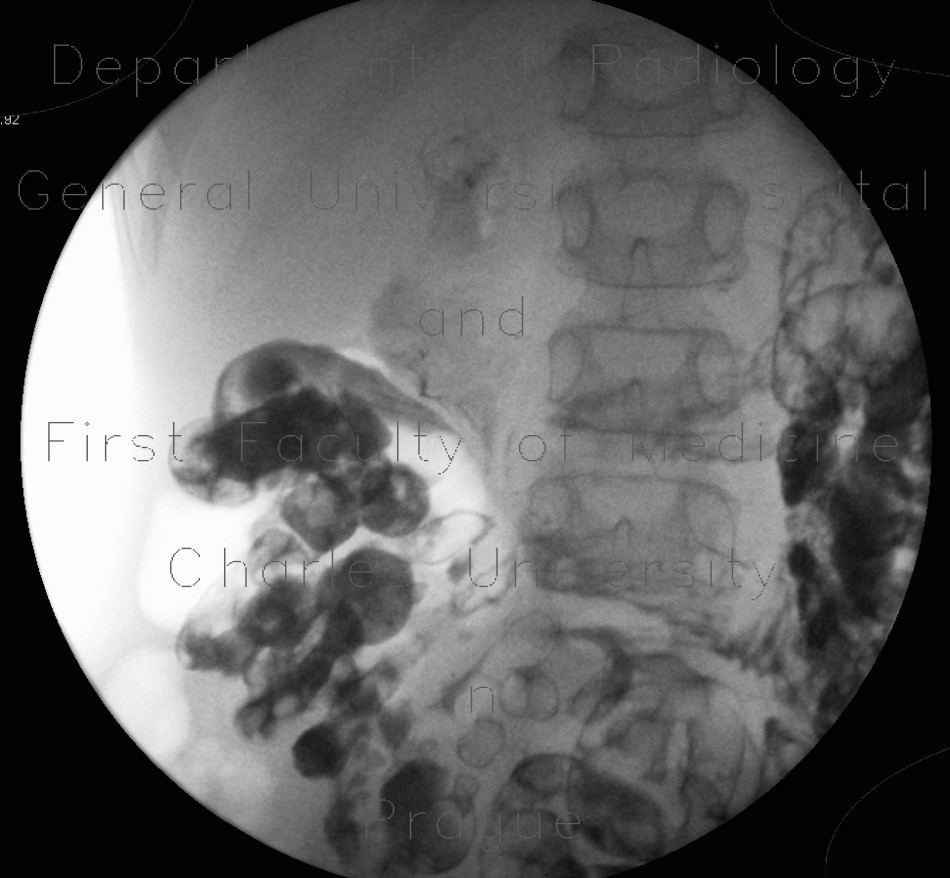 MNGIE, Mitochondrial neurogastrointestinal encephalopathy