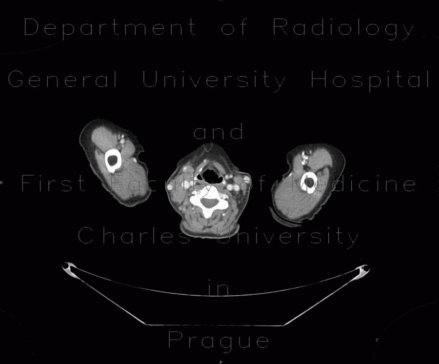 Malignant lymphoma, ultrasound of lymph nodes, correlation with CT and NM