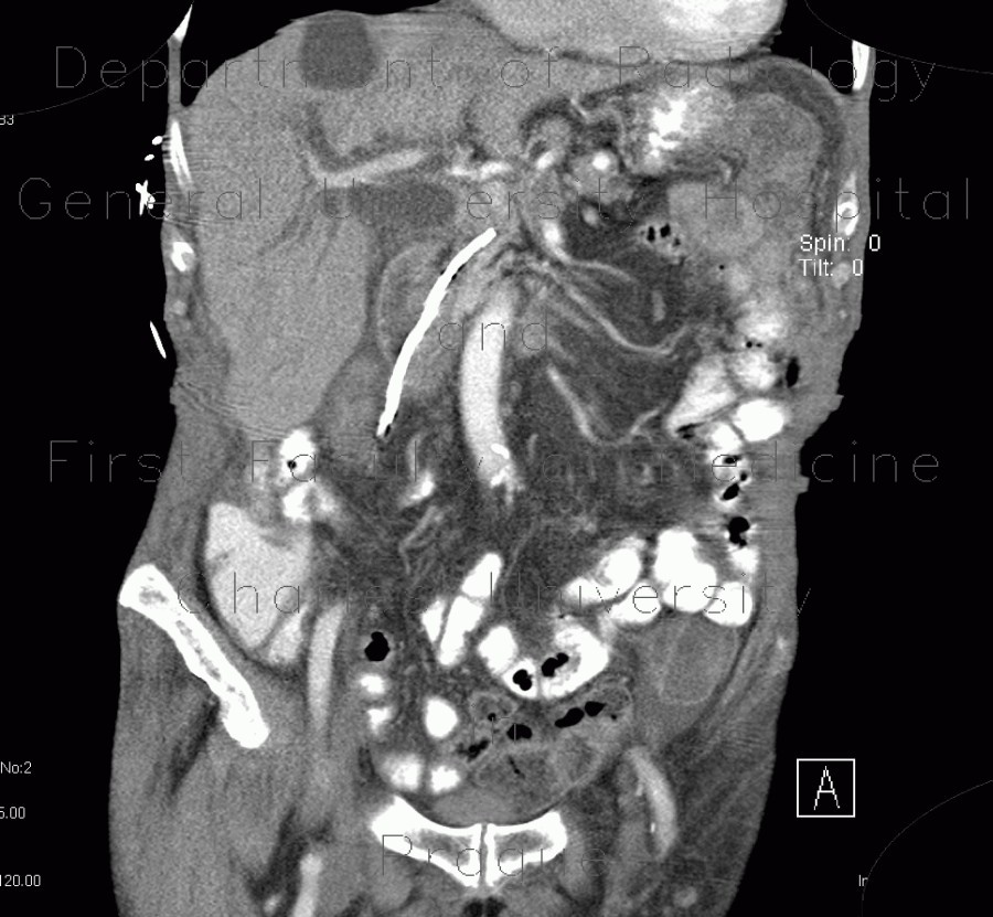 Malposition and migration of duodenobiliary stent, before removal