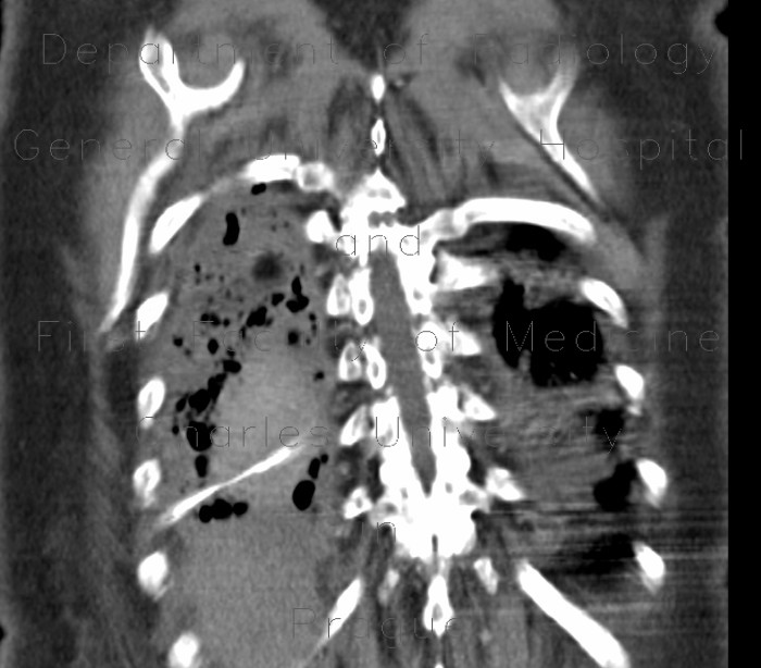 Malposition of nasogastric tube, hemothorax, pneumothorax