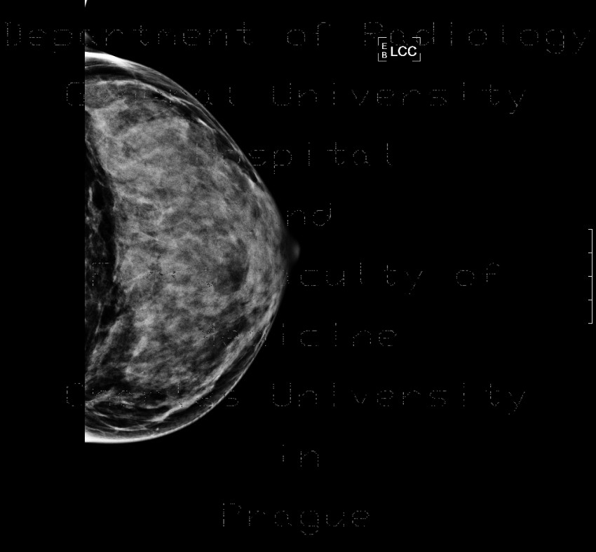 Mammography, dense type, normal finding