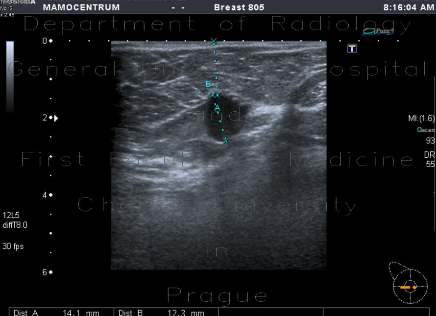 Marking of a breast tumour