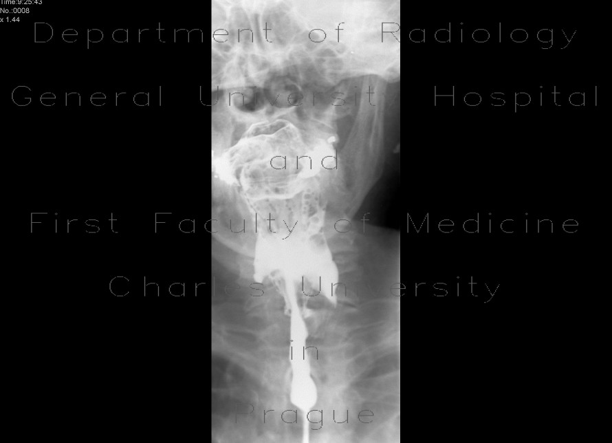 Massive aspiration, laryngeal dysphagia, tracheostomy