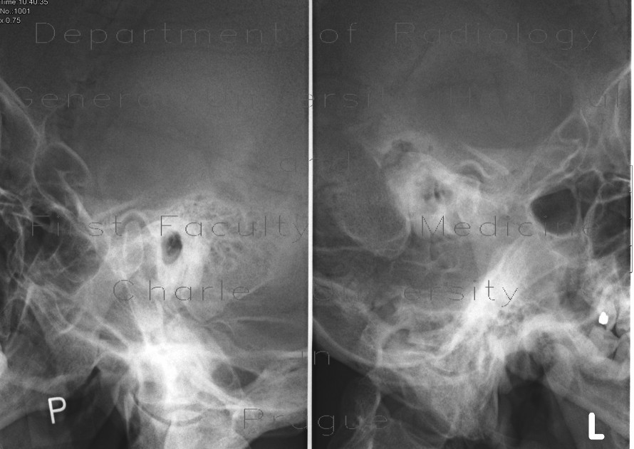 Mastoiditis, Schuller view