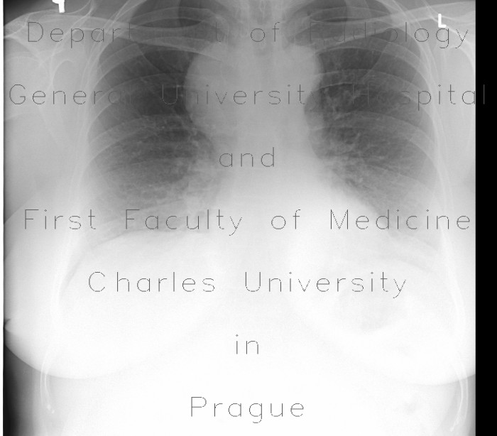 Mediastinal expansion