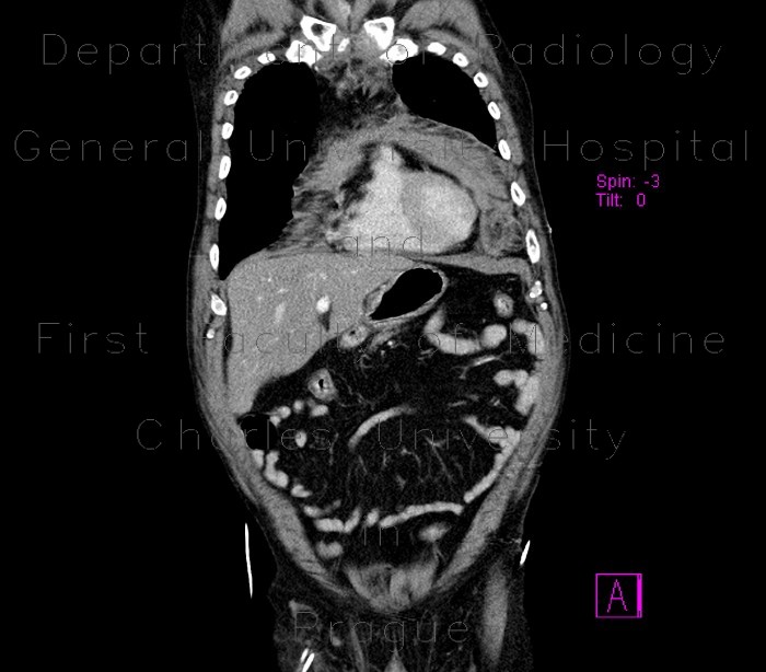Mediastinal hemorrhage