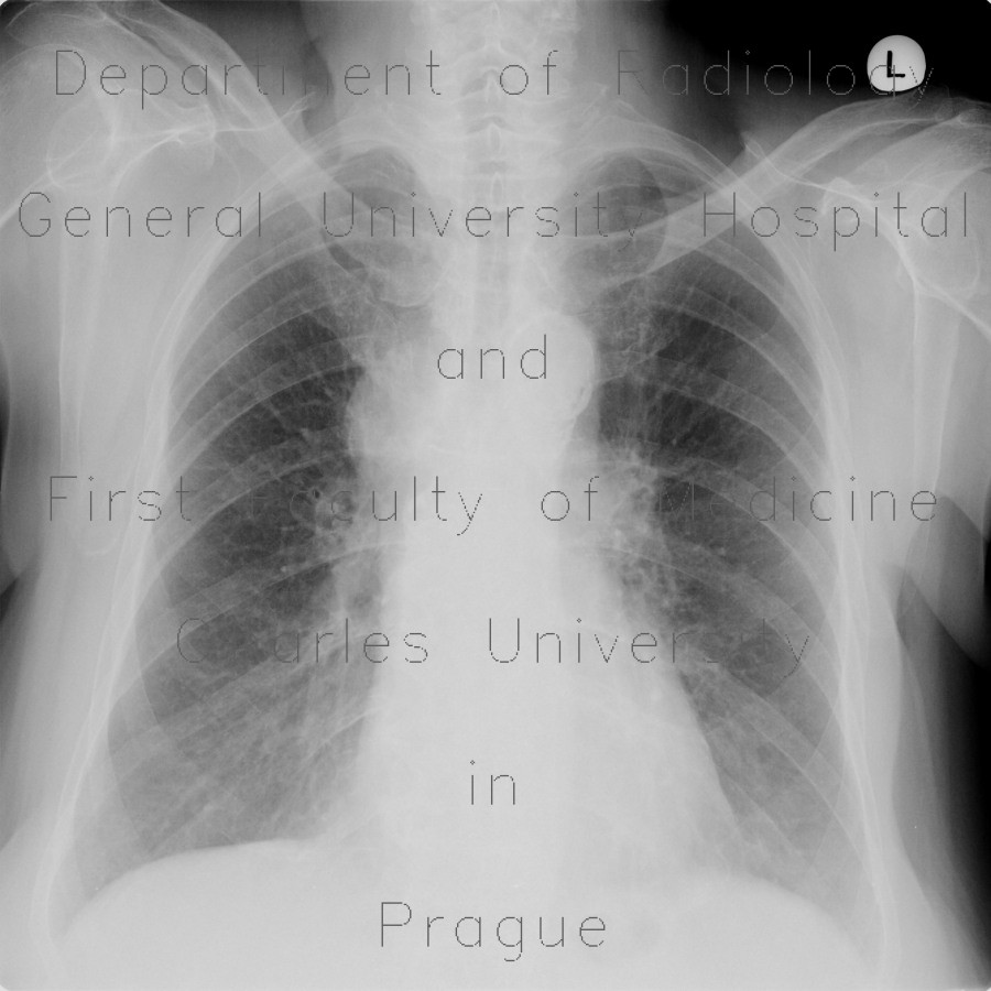 Mediastinal lymphadenopathy, malignant lymphoma, correlation