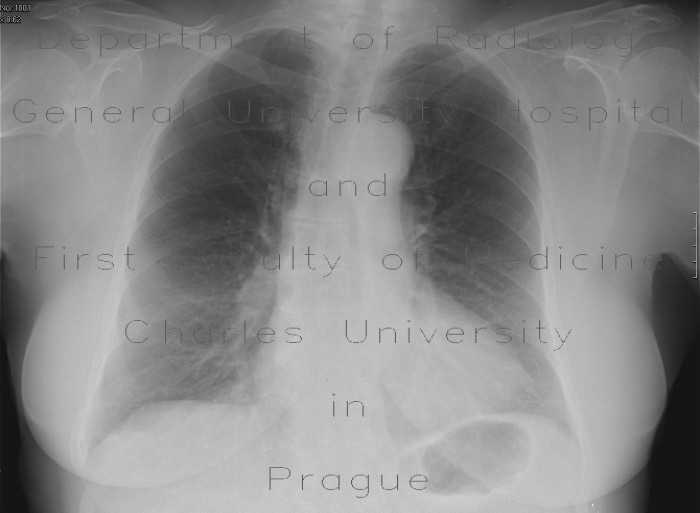 Mediastinal tumour, chest radiograph before