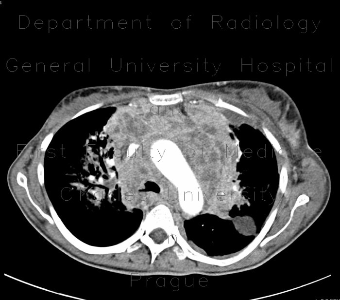 Melanoma of mediastinum