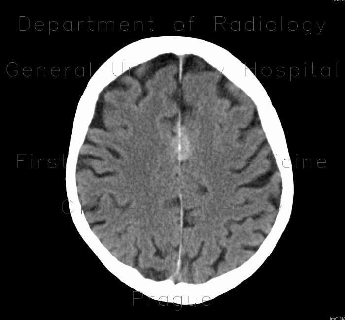 Meningioma of falx cerebri