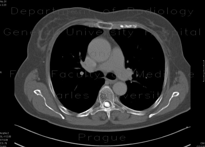 Meningioma of the spinal canal