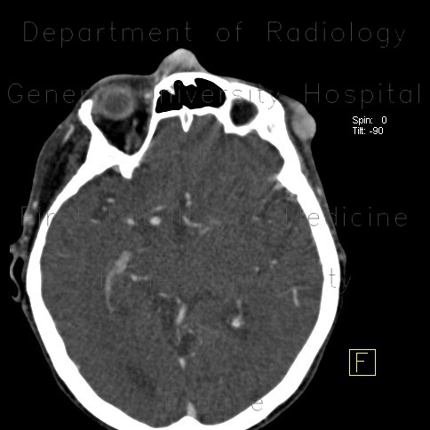 Merkel cell carcinoma, recurrence