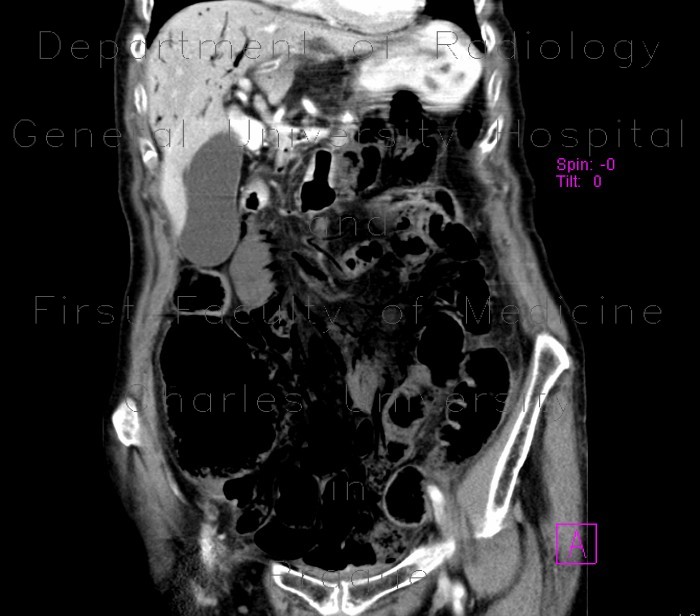 Mesenterial occlusion, gas in portal vein