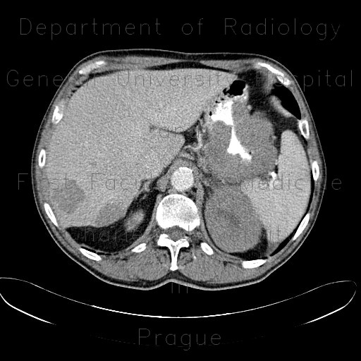 Metastases of malignant melanoma, liver, stomach, adrenal gland, retroperitoneal lymph nodes