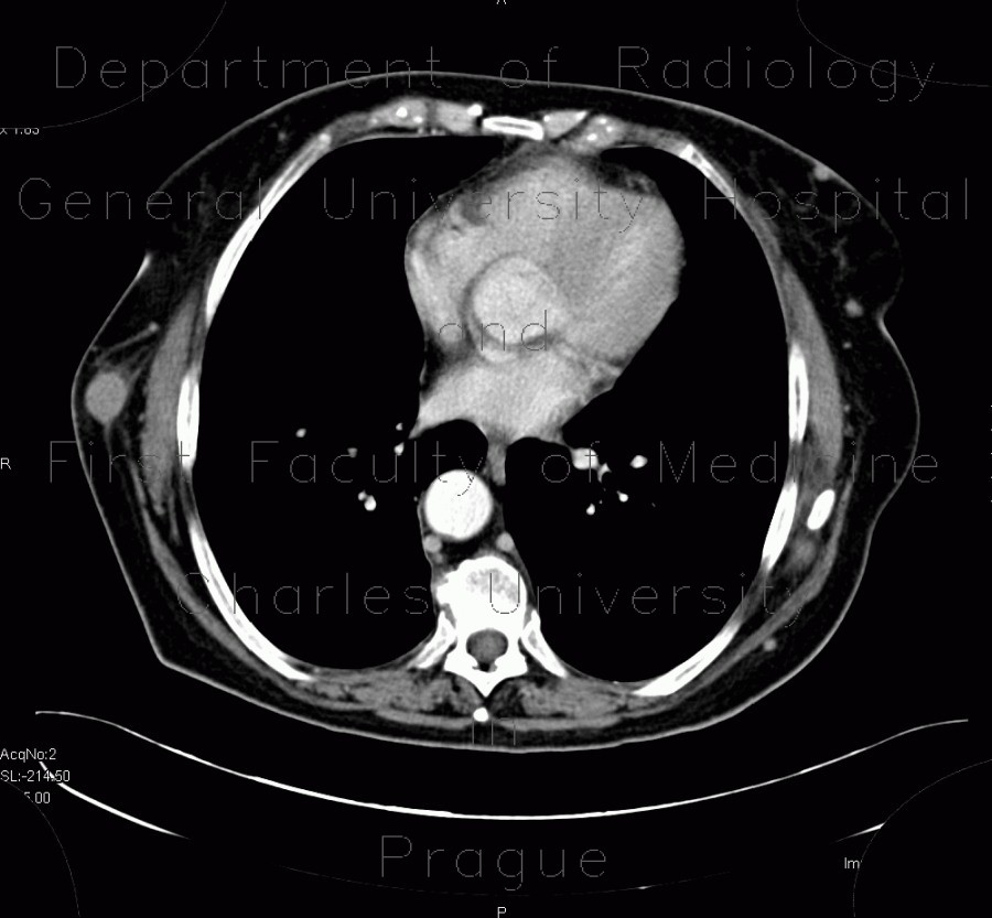 Metastasis of malignant melanoma into skin
