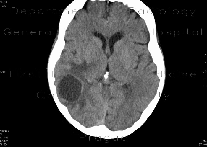 Metastatic disease of brain, lung, liver