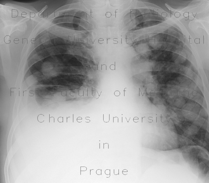 Metastatic disease of lung, cannon ball metastases