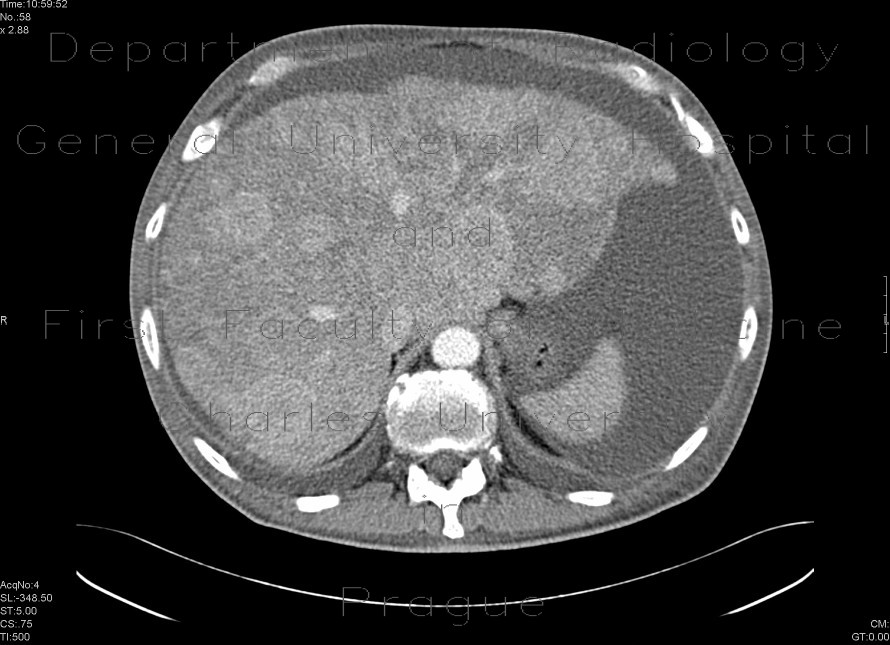 Metastatic disease of the liver