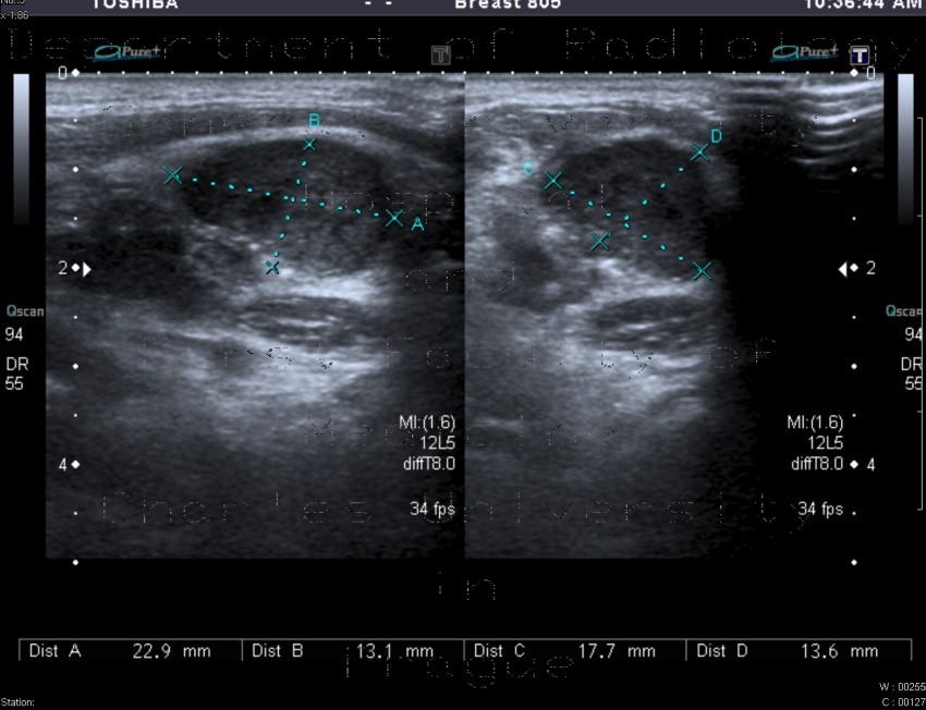 Metastatic infiltration of lymph nodes