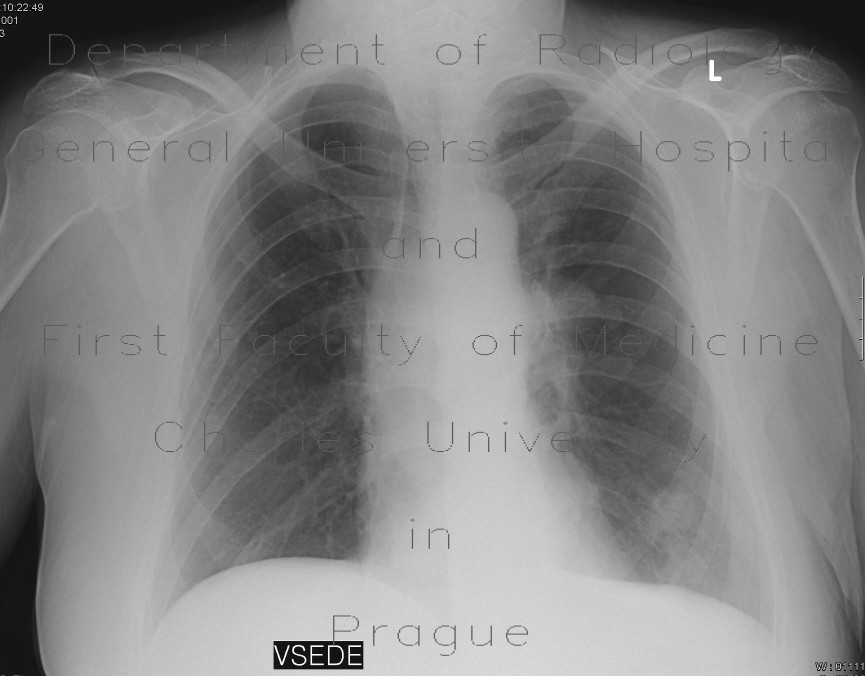 Metastatic lung disease